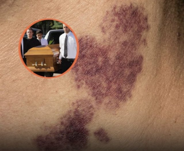 Detaje SH0KUESE: Adoleshenti hυmbi jetën pasi u kafshua në qafë nga e dashura