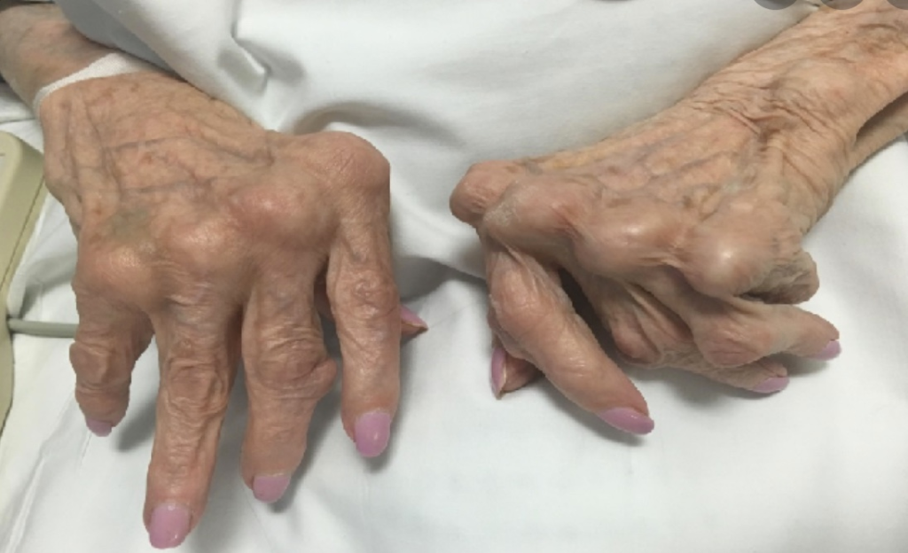 Rheumatoid ARTHRITISTë jetosh me artritin reumatoid: sfidat e përditshme